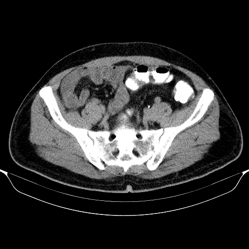 Colonic lipoma with colo-colic intussusception (Radiopaedia 58944-66200 Axial C+ rectal 54).jpg