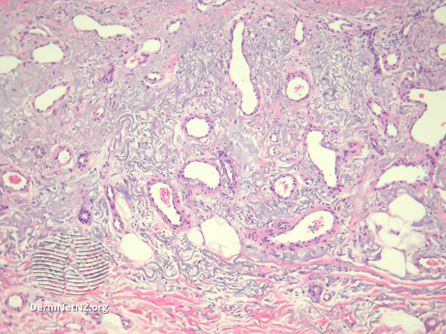 File:Figure 2 (DermNet NZ pathology-e-acquired-elastotic-haemangioma-figure-2).jpg