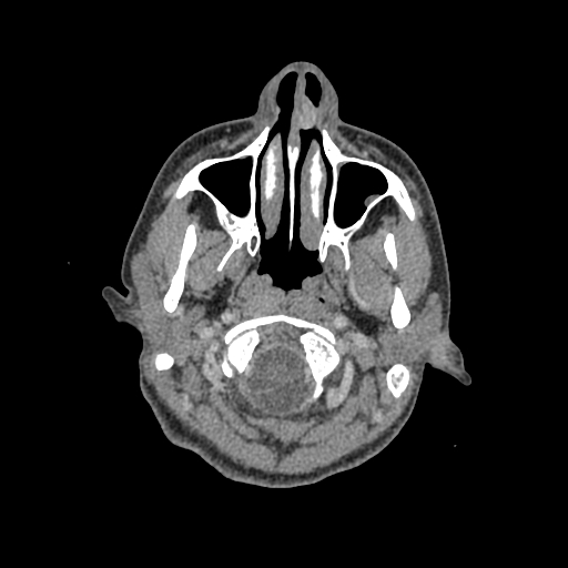 Nasal pyogenic granuloma (lobular capillary hemangioma) (Radiopaedia 85536-101244 C 27).jpg