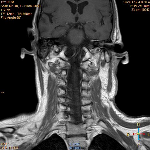 File:Nasopharyngeal carcinoma (Radiopaedia 22375-22403 Coronal T1 C+ 11).jpg