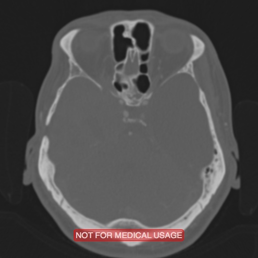 Nasopharyngeal carcinoma recurrence - skull base destruction (Radiopaedia 29107-29490 Axial bone window 72).jpg