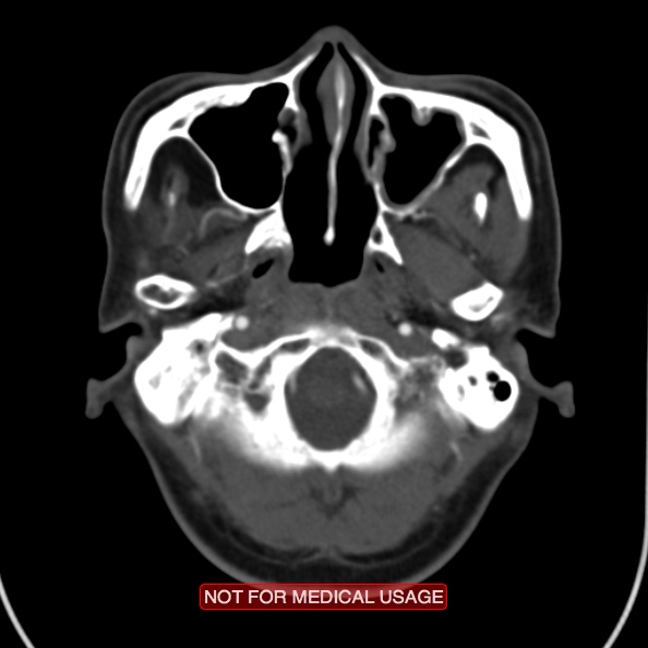 File:Nasopharyngeal carcinoma recurrence - skull base destruction (Radiopaedia 29107-29491 A 9).jpg
