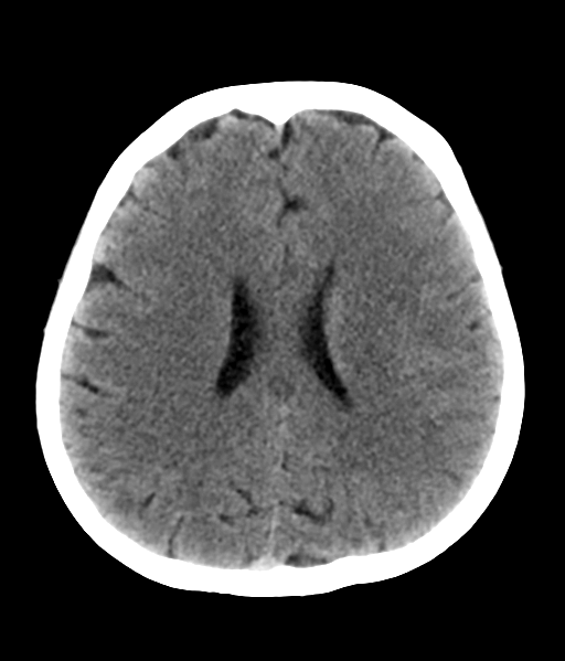 File:Nasopharyngeal carcinoma with cerebral abscess (Radiopaedia 43018-46275 Axial non-contrast 34).png