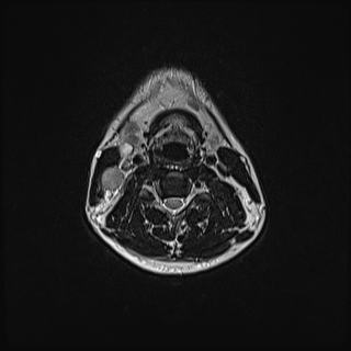 Nasopharyngeal carcinoma with perineural spread (Radiopaedia 55030-61380 Axial T2 56).jpg