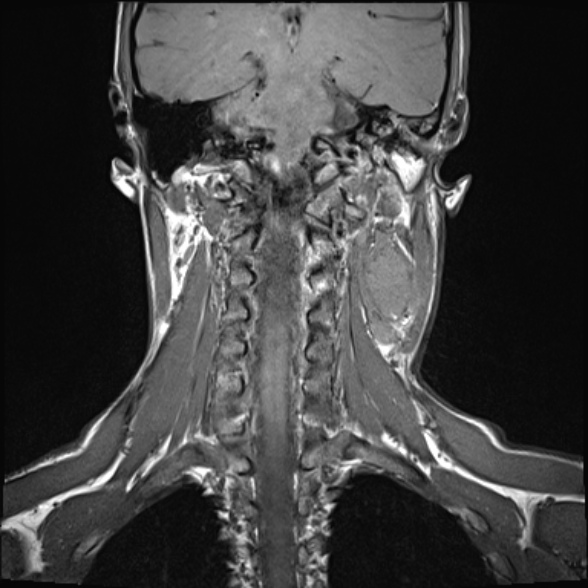 Nasopharyngeal carcinoma with skull base invasion (Radiopaedia 53415-59485 Coronal T1 10).jpg