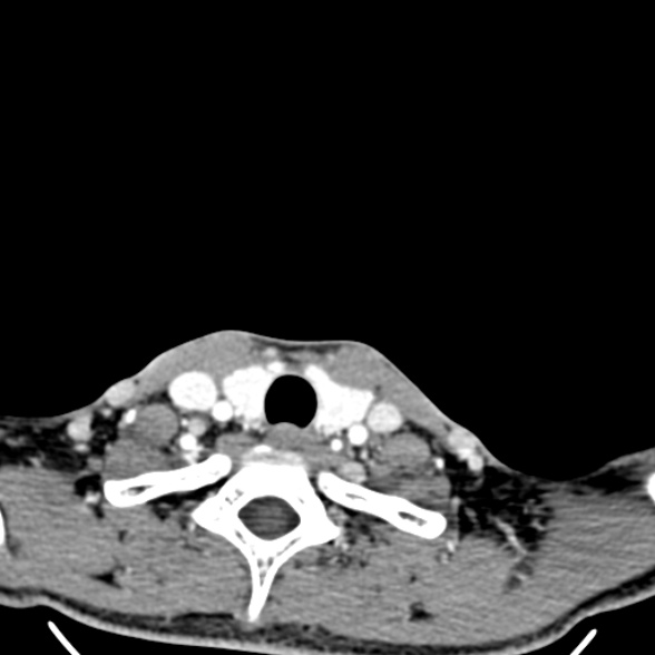 Nasopharyngeal carcinoma with skull base invasion (Radiopaedia 53415-59705 A 182).jpg