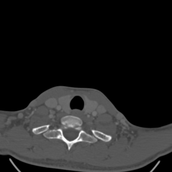 File:Nasopharyngeal carcinoma with skull base invasion (Radiopaedia 53415-59705 Axial bone window 176).jpg