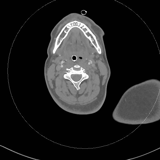 Neck CT angiogram (intraosseous vascular access) (Radiopaedia 55481-61945 B 198).jpg