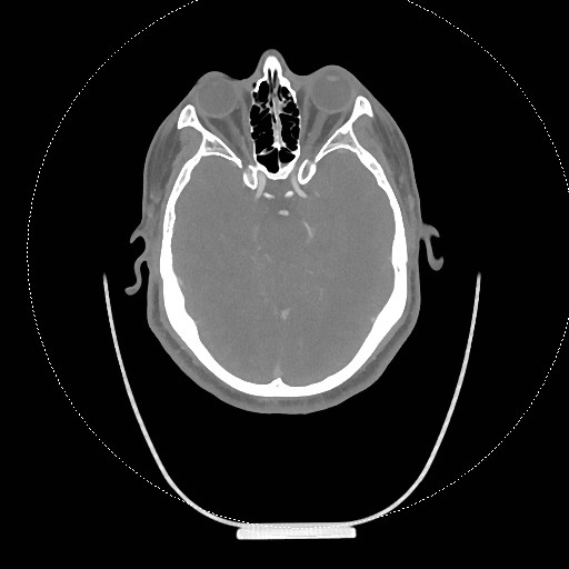 Neck CT angiogram (intraosseous vascular access) (Radiopaedia 55481-61945 B 293).jpg