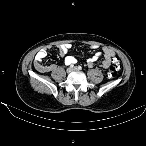 Necrotizing pancreatitis (Radiopaedia 87796-104249 A 38).jpg