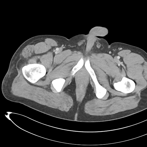 File:Necrotizing pancreatitis with acute necrotic collections (Radiopaedia 38829-41012 B 91).png