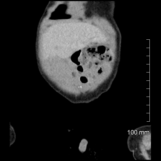 File:Neonatal neuroblastoma (Radiopaedia 56651-63438 Coronal non-contrast 8).jpg