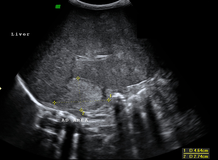 File:Neonatal neuroblastoma (Radiopaedia 9564-10221 A 3).jpg