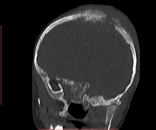 File:Neuroblastoma skull metastasis (Radiopaedia 56053-62683 Coronal bone window 15).jpg