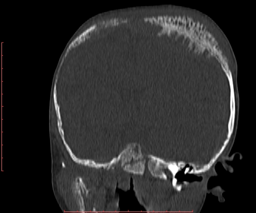File:Neuroblastoma skull metastasis (Radiopaedia 56053-62683 Coronal bone window 19).jpg