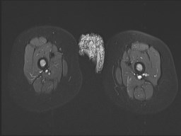 File:Neuroblastoma with bone metastases (Radiopaedia 67080-76414 Axial STIR 30).jpg