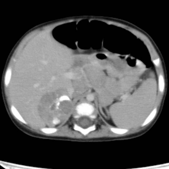 Neuroblastoma with skull metastases (Radiopaedia 30326-30960 C 15).jpg