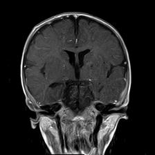 File:Neurofibromatosis type 1 (Radiopaedia 30089-30671 Coronal T1 C+ 14).jpg
