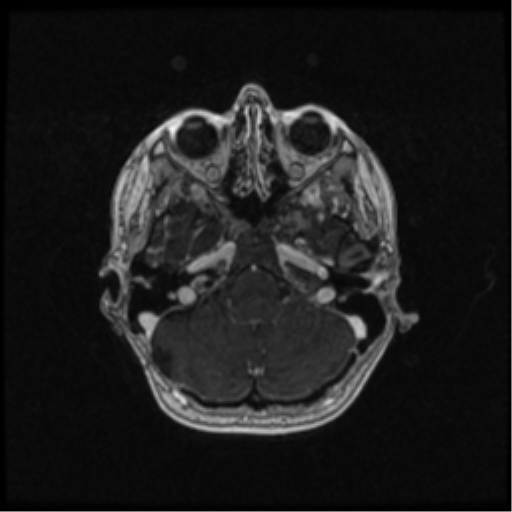 Neurofibromatosis type 2 (Radiopaedia 45229-49244 Axial T1 C+ 36).png