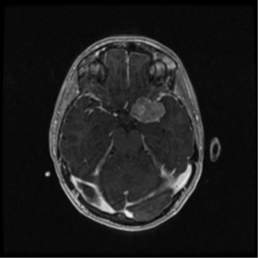 Neurofibromatosis type 2 (Radiopaedia 45229-49244 Axial T1 C+ 51).png