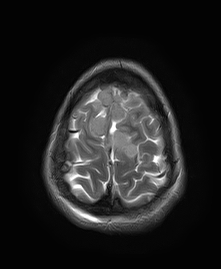 File:Neurofibromatosis type 2 (Radiopaedia 66211-75401 Axial T2 25).jpg