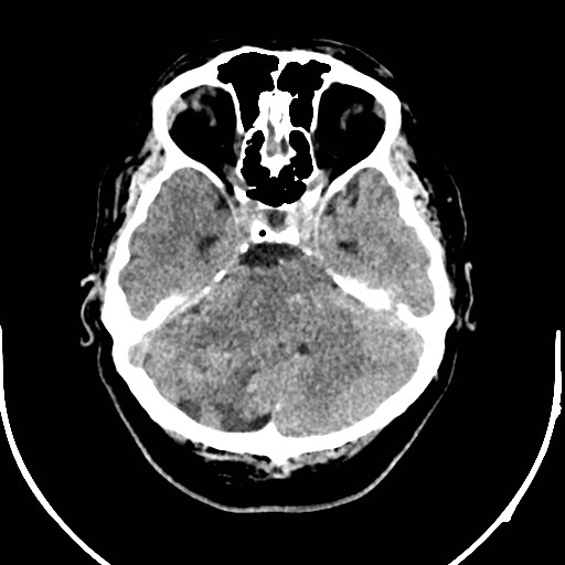 Neurofibromatosis type 2 (Radiopaedia 79097-92047 Axial non-contrast 16).jpg