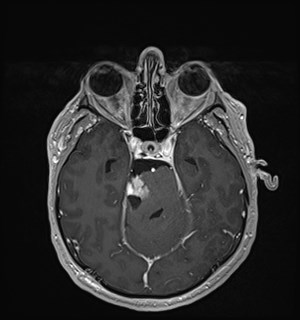 Neurofibromatosis type 2 (Radiopaedia 79097-92049 Axial T1 C+ 75).jpg