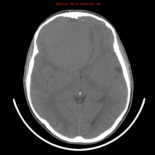 File:Neurofibromatosis type 2 (Radiopaedia 8953-9732 Axial non-contrast 18).jpg