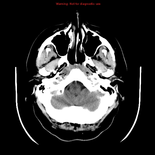 File:Neuroglial cyst (Radiopaedia 10713-11185 Axial non-contrast 28).jpg