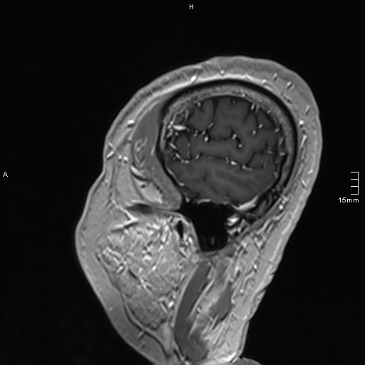 Neurosarcoidosis - involvement of the mesial temporal lobes (Radiopaedia 67429-76820 Sagittal T1 C+ 149).jpg