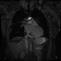 File:Non-compaction of the left ventricle (Radiopaedia 38868-41062 Coronal SSFP 2D FS 6).jpg