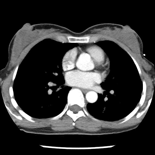 File:Non-small cell lung cancer with miliary metastases (Radiopaedia 23995-24193 A 24).jpg