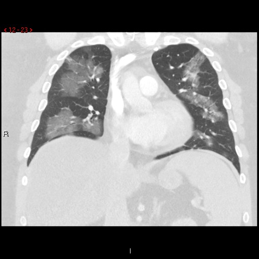 File:Non-specific interstitial pneumonitis (Radiopaedia 27044-27222 Coronal lung window 23).jpg