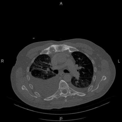 Non Hodgkin lymphoma in a patient with ankylosing spondylitis (Radiopaedia 84323-99624 Axial bone window 12).jpg
