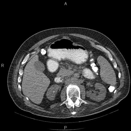 File:Non Hodgkin lymphoma in a patient with ankylosing spondylitis (Radiopaedia 84323-99624 Axial non-contrast 39).jpg