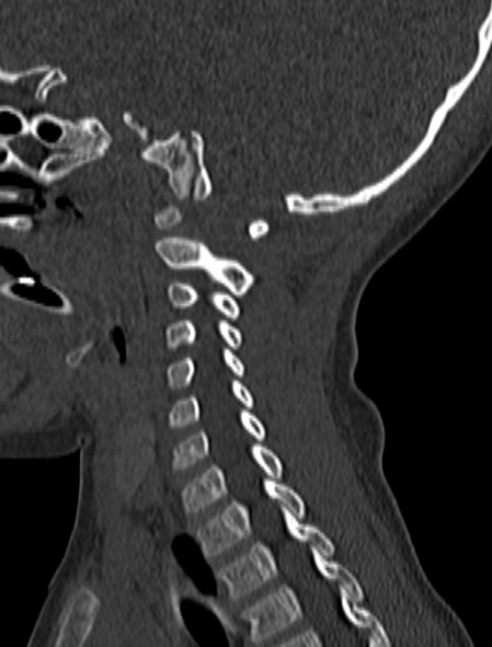 File:Normal CT cervical spine - pediatric (Radiopaedia 52549-58462 Sagittal bone window 64).jpg