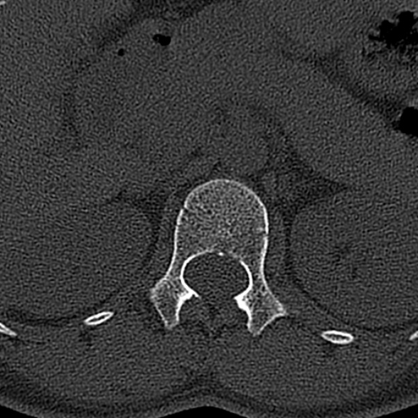 File:Normal CT lumbar spine (Radiopaedia 53981-60118 Axial bone window 11).jpg