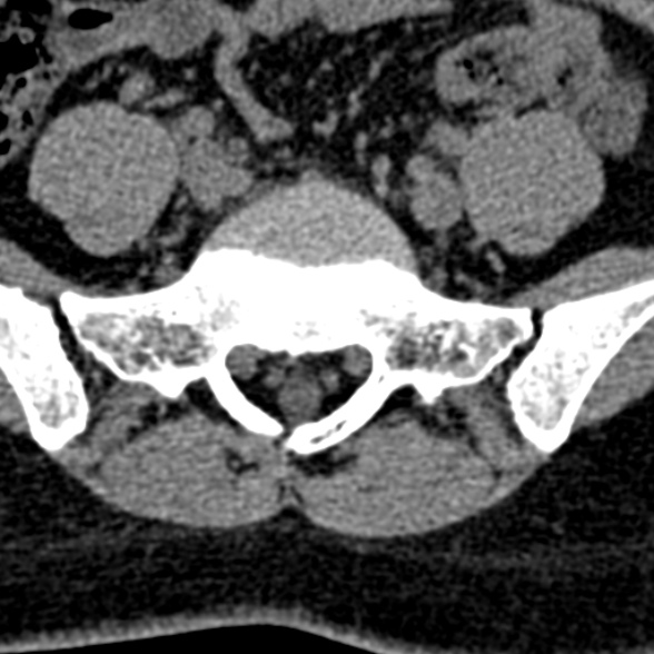 Normal CT lumbar spine (Radiopaedia 53981-60118 Axial non-contrast 89).jpg