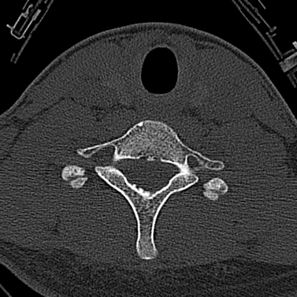 Normal CT of the cervical spine (Radiopaedia 53322-59305 Axial bone window 208).jpg