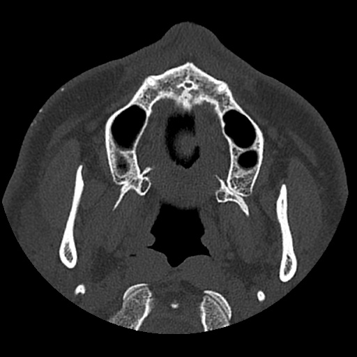 Normal CT paranasal sinuses (Radiopaedia 42286-45390 Axial bone window 95).jpg