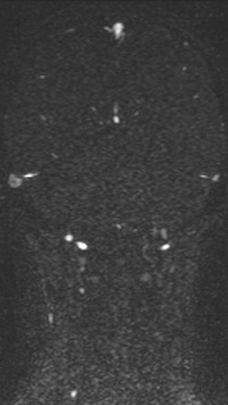 Normal MRI brain with MRV- teenager (Radiopaedia 49425-54553 Coronal MRV 175).jpg