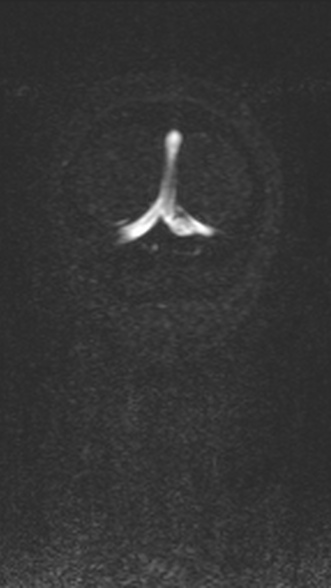 Normal MRI brain with MRV- teenager (Radiopaedia 49425-54553 Coronal MRV 214).jpg