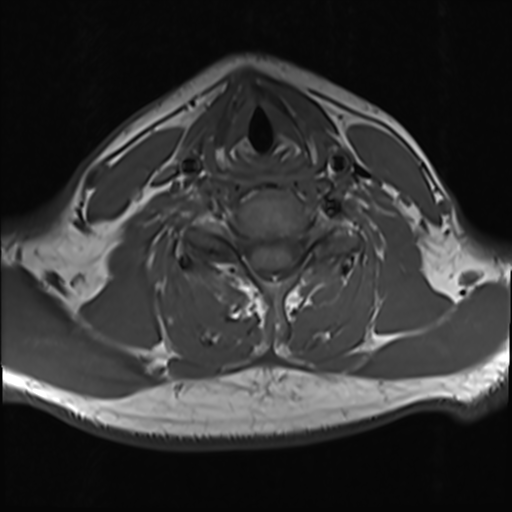 File:Normal MRI cervical spine (infection protocol) (Radiopaedia 53916-60039 Axial 34).png