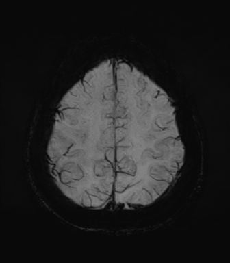 Normal MRI internal auditory canal (Radiopaedia 41613-44525 Axial SWI MIP 64).png