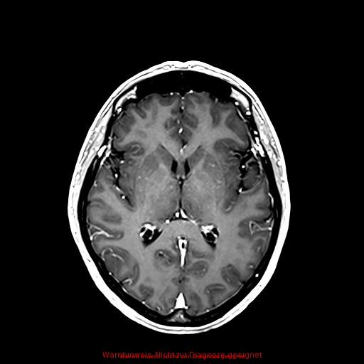 Normal adult brain MRI (non-enhanced and contrast-enhanced) (Radiopaedia 75262-86379 Axial T1 C+ 106).jpg