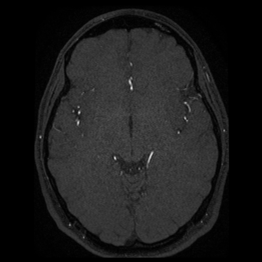Normal brain MRA (Radiopaedia 41046-43793 Axial MRA 35).png