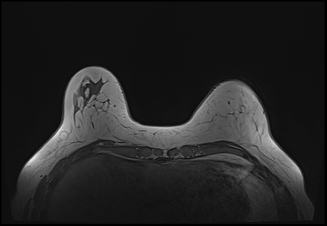 File:Normal breast MRI - dense breasts (Radiopaedia 80454-93850 Axial T1 50).jpg