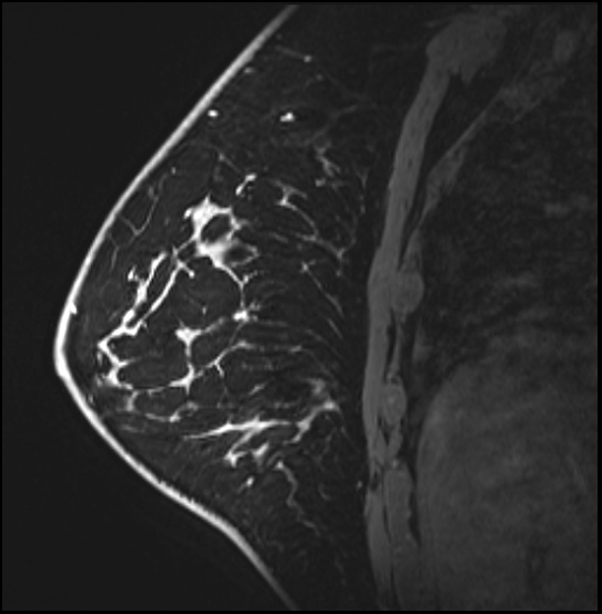 Normal breast MRI - dense breasts (Radiopaedia 80454-93850 I 128).jpg