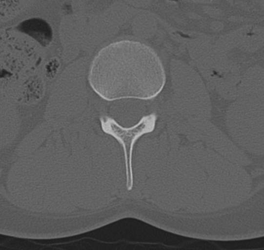 File:Normal lumbar spine CT (Radiopaedia 46533-50986 Axial bone window 26).png