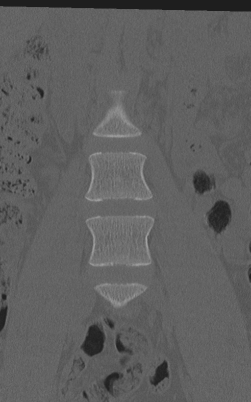 Normal lumbar spine CT (Radiopaedia 46533-50986 Coronal bone window 18).png